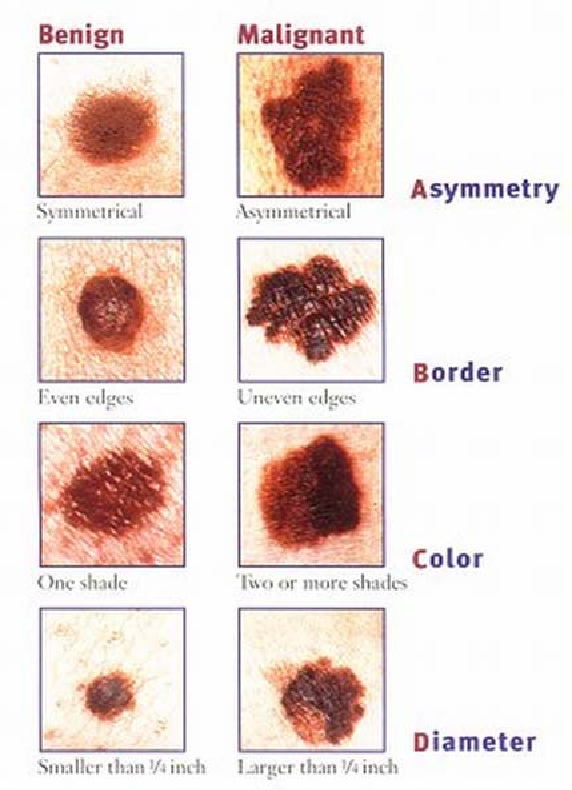 The key attributes of melanoma, a dangerous skin cancer